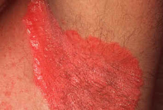 Calentar los pies al vapor a la psoriasis